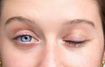 Yüz Felcinde Soğuk Hava Masum mu?